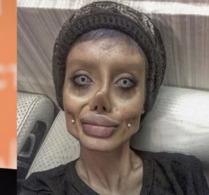 Se opera más de 50 veces para parecerse a Angelina Jolie Se opera más de 50 veces para parecerse a Angelina Jolie