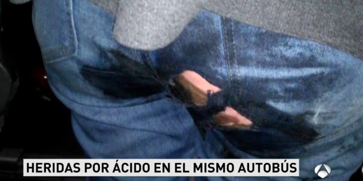 Heridas por ácido