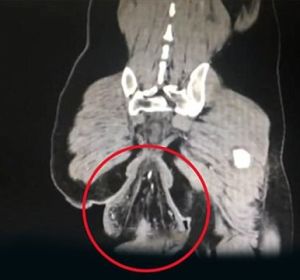 La imagen del prolapso rectal La imagen del prolapso rectal