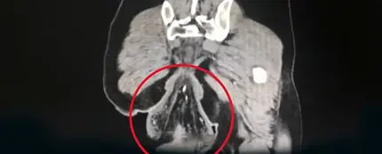 La imagen del prolapso rectal La imagen del prolapso rectal