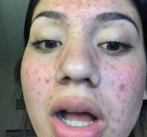 Karina, la joven que consiguió eliminar el acné con productos naturales Karina, la joven que consiguió eliminar el acné con productos naturales