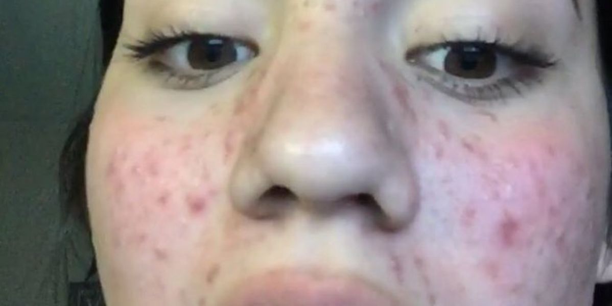 Karina, la joven que consiguió eliminar el acné con productos naturales