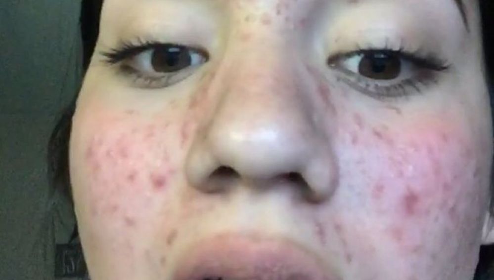 Karina, la joven que consiguió eliminar el acné con productos naturales