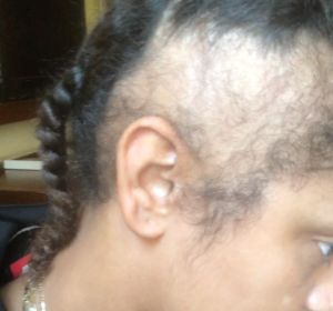 Paigey Cakey, la joven que sufre alopecia de tracción Paigey Cakey, la joven que sufre alopecia de tracción