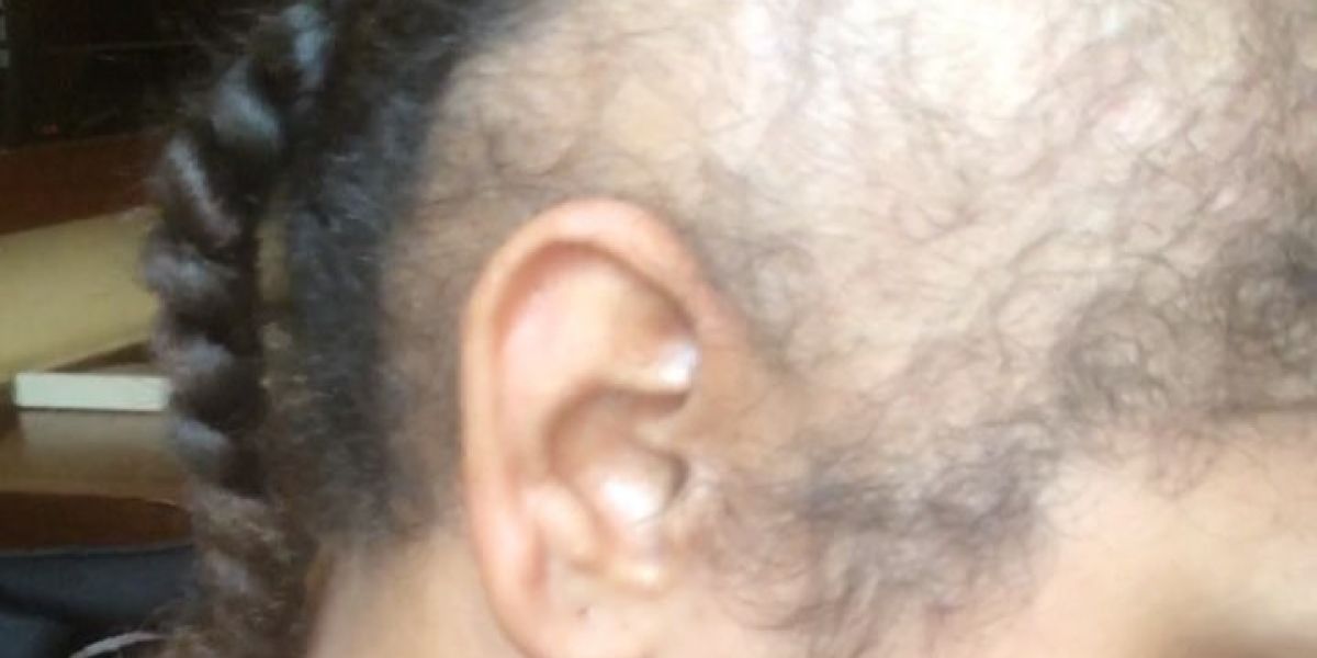Paigey Cakey, la joven que sufre alopecia de tracción
