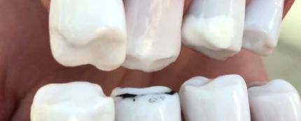 Uñas con forma de dientes