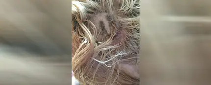 Joven con quemaduras de segundo grado en la cabeza Joven con quemaduras de segundo grado en la cabeza