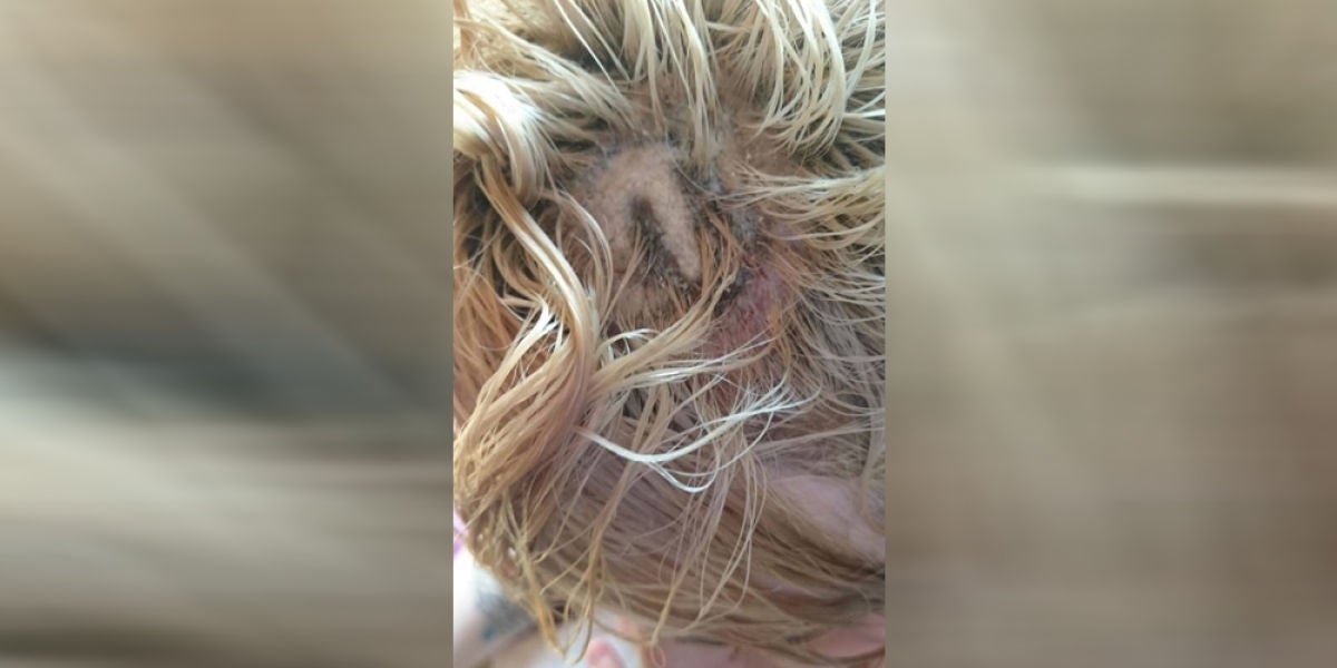 Joven con quemaduras de segundo grado en la cabeza