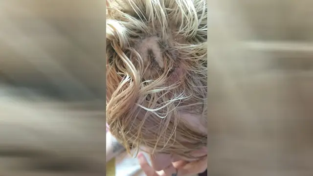 Joven con quemaduras de segundo grado en la cabeza