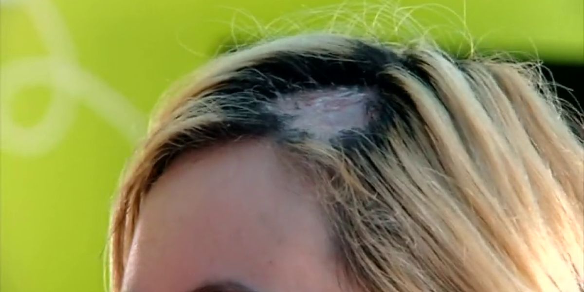 Una mujer sufre quemaduras en la cabeza al teñirse el pelo