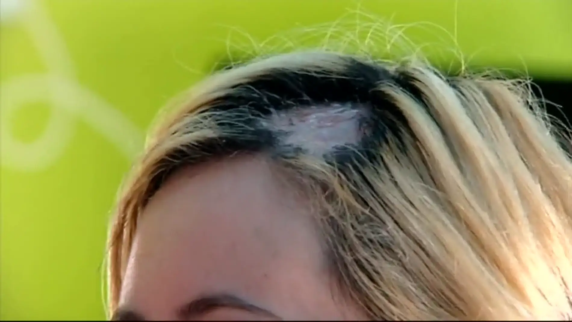 Una mujer sufre quemaduras en la cabeza al teñirse el pelo