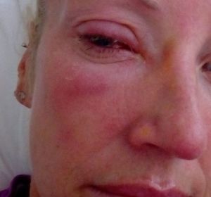 Suzzane Dunne ciega tras devorarle la córnea un parásito Suzzane Dunne ciega tras devorarle la córnea un parásito