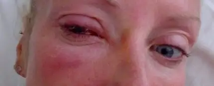 Suzzane Dunne ciega tras devorarle la córnea un parásito Suzzane Dunne ciega tras devorarle la córnea un parásito