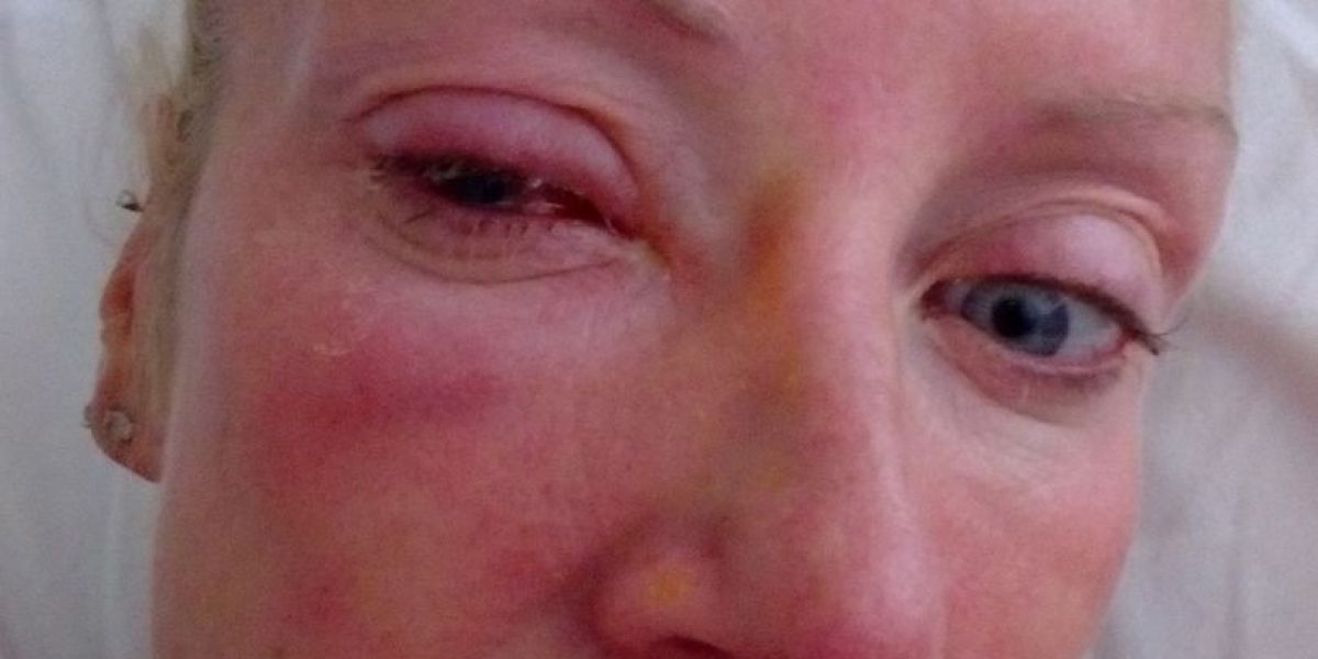 Suzzane Dunne ciega tras devorarle la córnea un parásito