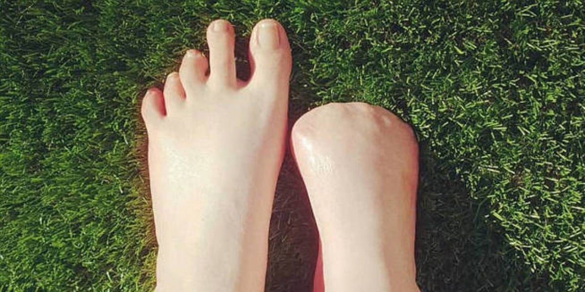 Pies de Victoria Curthoys, la australiana que perdió sus dedos