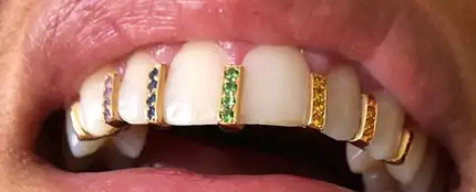 Adornos en los dientes Adornos en los dientes