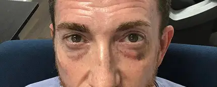 Pablo Motos nos enseña su ojo morado Pablo Motos nos enseña su ojo morado
