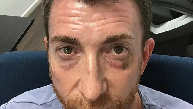 Pablo Motos nos enseña su ojo morado