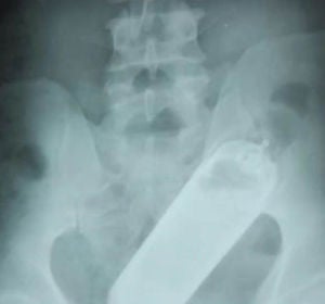 Una radiografía reveló que el hombre tenía un frasco de perfume en el recto Una radiografía reveló que el hombre tenía un frasco de perfume en el recto