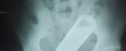 Una radiografía reveló que el hombre tenía un frasco de perfume en el recto Una radiografía reveló que el hombre tenía un frasco de perfume en el recto