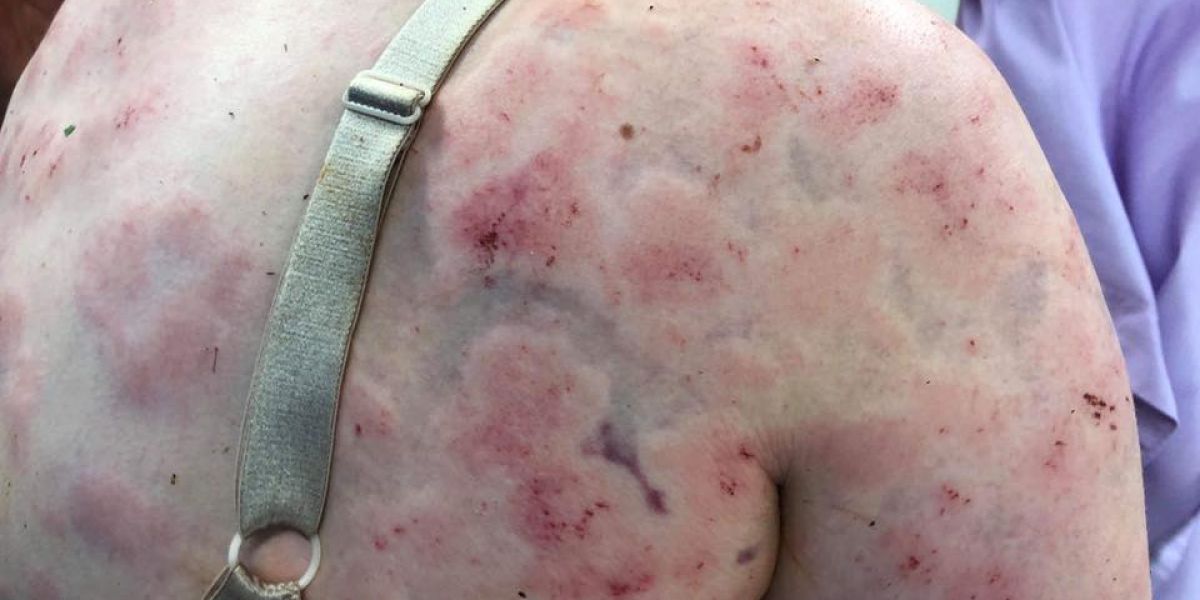 La heridas que sufrió la mujer