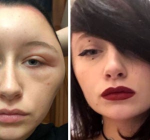 Una joven sufre una reacción alérgica que le deforma la cara Una joven sufre una reacción alérgica que le deforma la cara