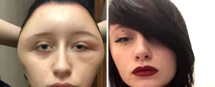Una joven sufre una reacción alérgica que le deforma la cara Una joven sufre una reacción alérgica que le deforma la cara