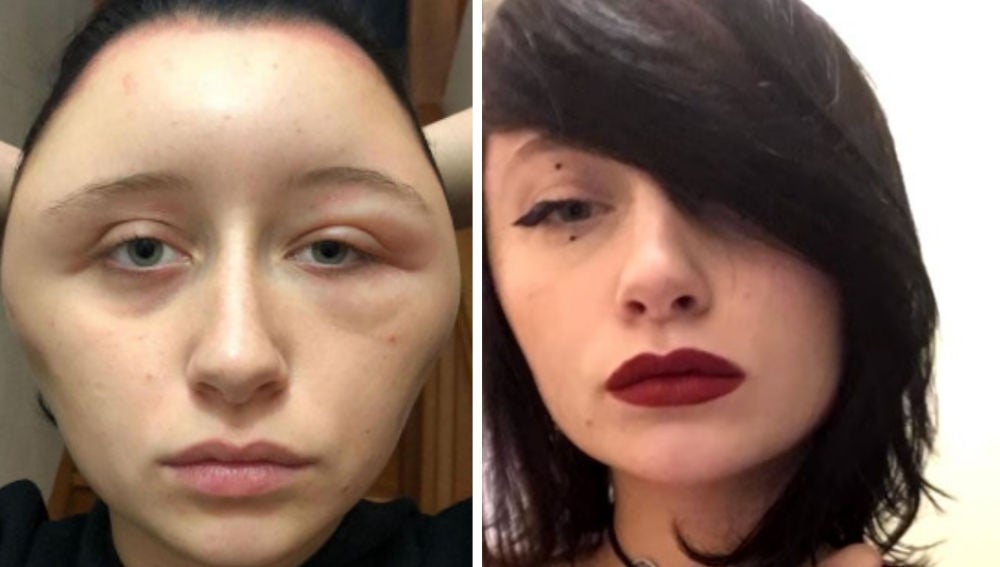 Una joven sufre una reacción alérgica que le deforma la cara 