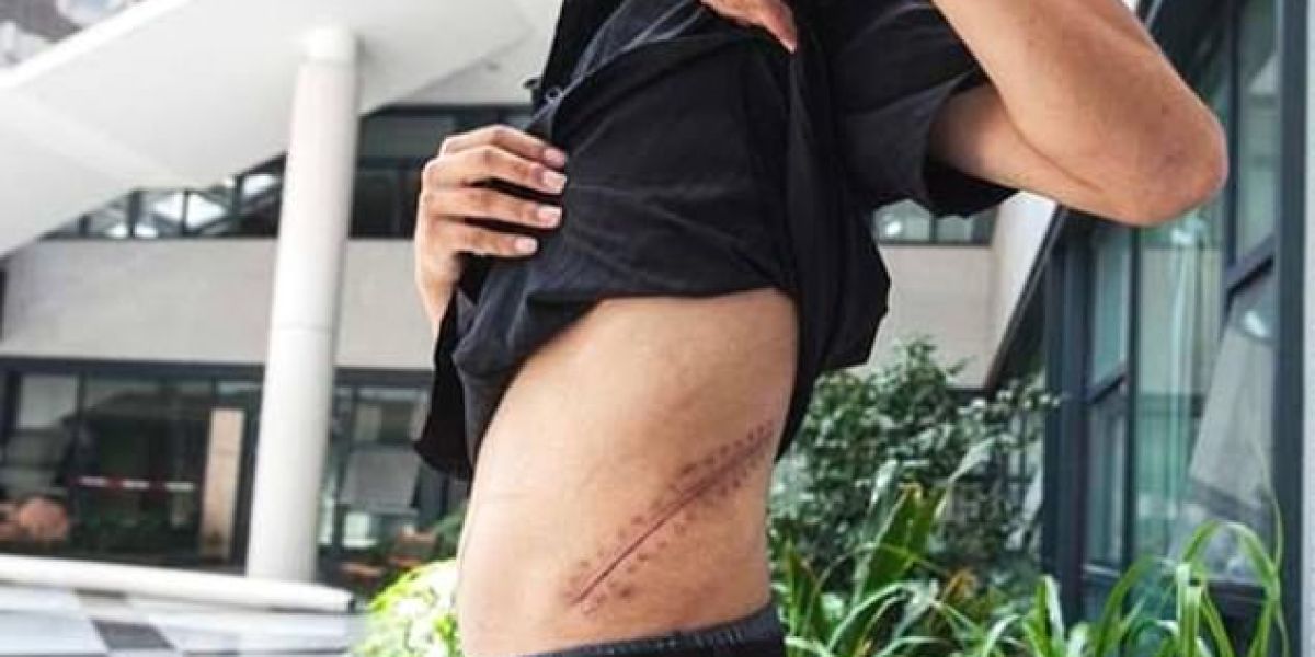 Xiao Wang muestra su cicatriz.