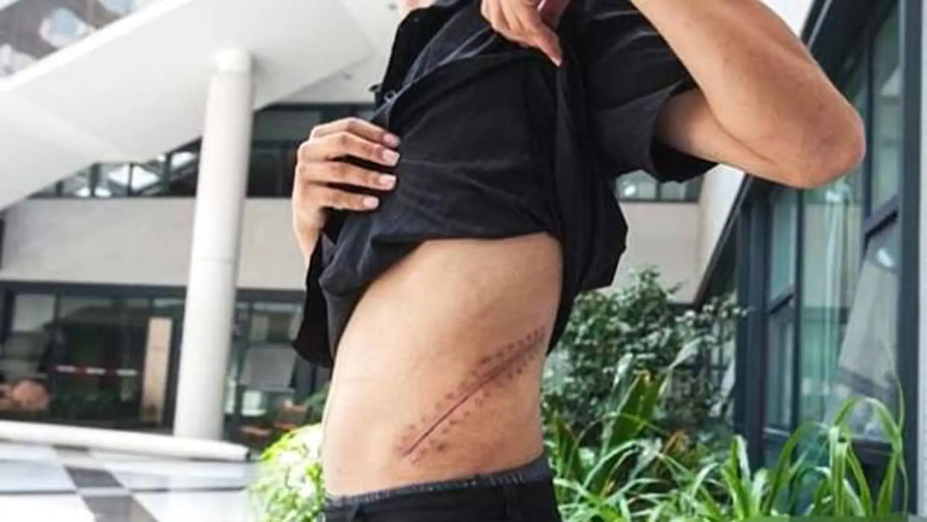 Xiao Wang muestra su cicatriz.