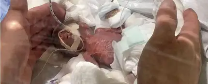 Imagen del bebé tras nacer Imagen del bebé tras nacer
