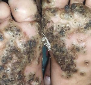 Imagen de los pies de la paciente con tungiasis. Imagen de los pies de la paciente con tungiasis.