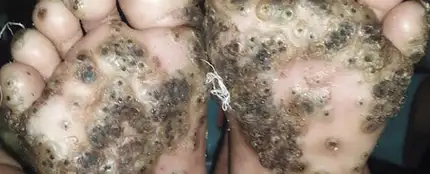 Imagen de los pies de la paciente con tungiasis. Imagen de los pies de la paciente con tungiasis.