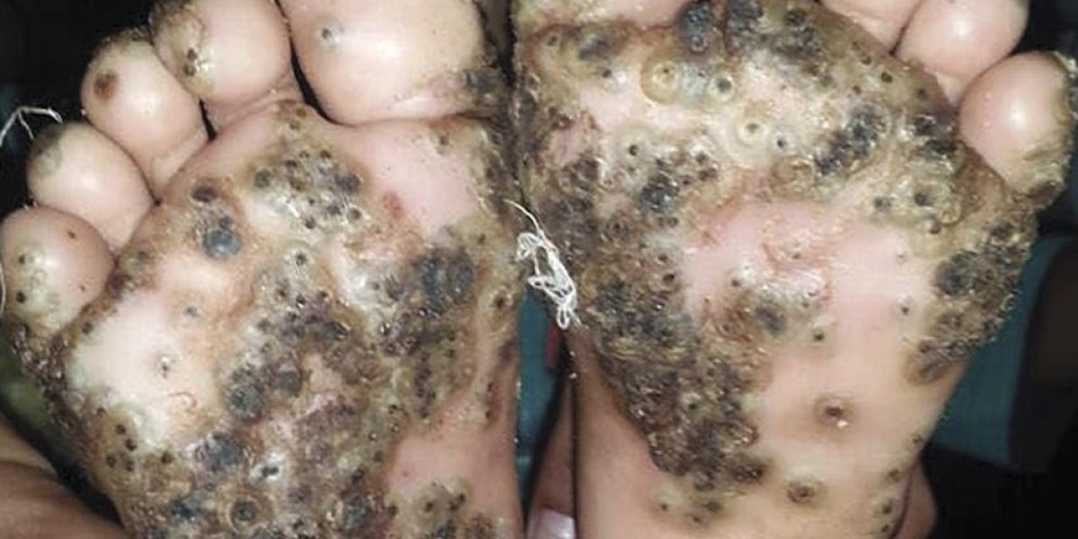 Imagen de los pies de la paciente con tungiasis.