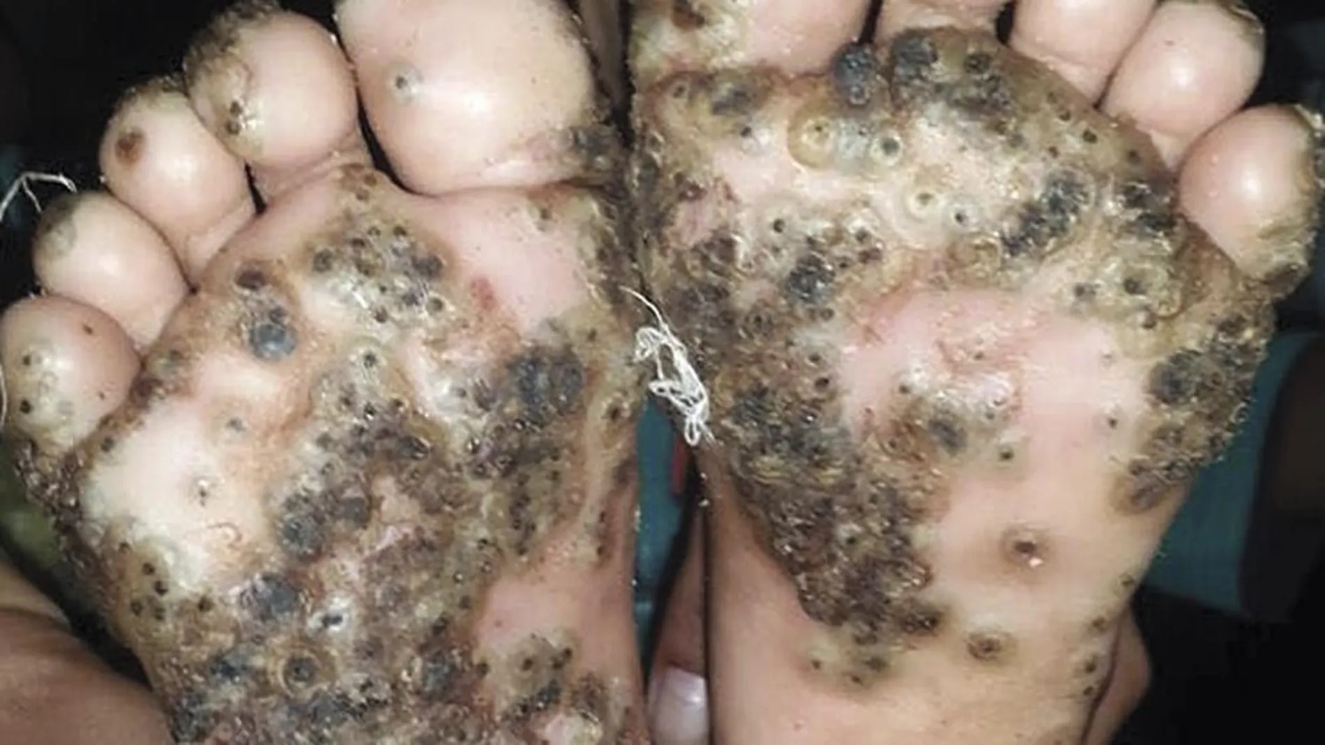 Imagen de los pies de la paciente con tungiasis. Imagen de los pies de la paciente con tungiasis.