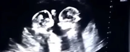 La pelea de dos gemelas en el vientre de su madre La pelea de dos gemelas en el vientre de su madre
