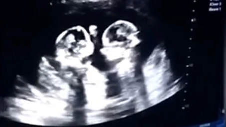 La pelea de dos gemelas en el vientre de su madre