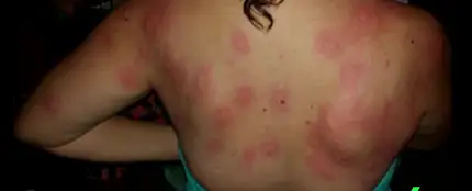 El mosquito más letal del mundo llega a España: hay tres casos de picadura del insecto responsable de 750.000 muertes al año El mosquito más letal del mundo llega a España: hay tres casos de picadura del insecto responsable de 750.000 muertes al año