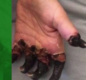 Amputan las piernas y la mano de una mujer por un diagnóstico erróneo de su médico Amputan las piernas y la mano de una mujer por un diagnóstico erróneo de su médico