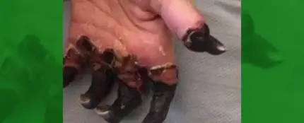 Amputan las piernas y la mano de una mujer por un diagnóstico erróneo de su médico Amputan las piernas y la mano de una mujer por un diagnóstico erróneo de su médico