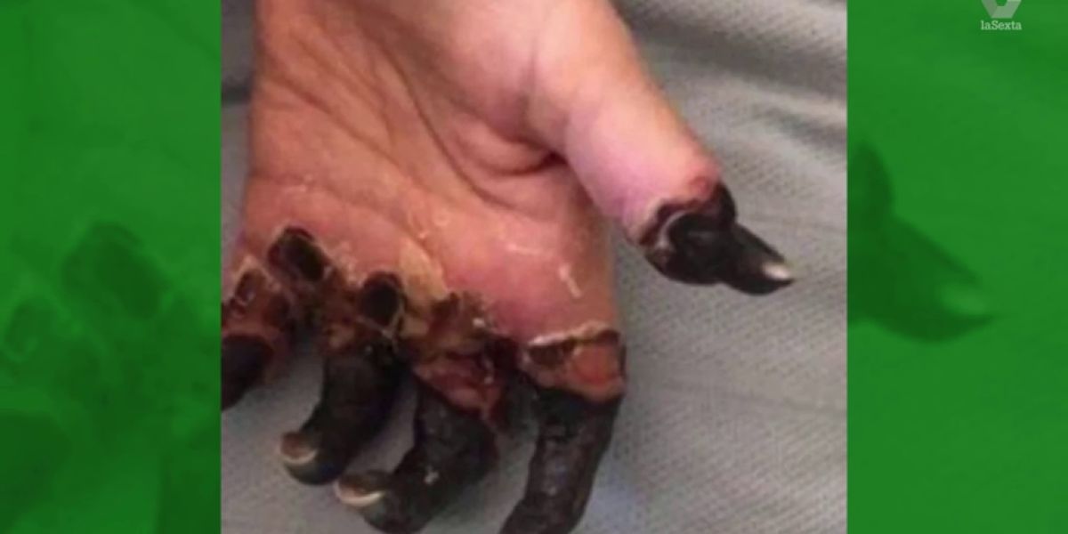 Amputan las piernas y la mano de una mujer por un diagnóstico erróneo de su médico
