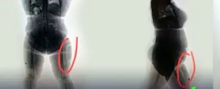Interceptan a una mujer que pretendía viajar a España con cocaína implantada en la pierna Interceptan a una mujer que pretendía viajar a España con cocaína implantada en la pierna