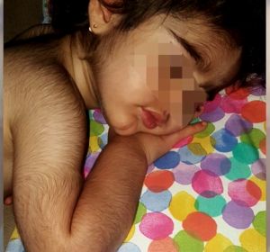 Niña con hipertricosis por omeprazol contaminado Niña con hipertricosis por omeprazol contaminado