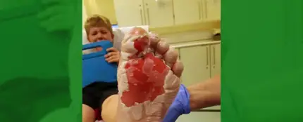 Un niño pisa unas brasas enterradas bajo la arena de la playa Un niño pisa unas brasas enterradas bajo la arena de la playa