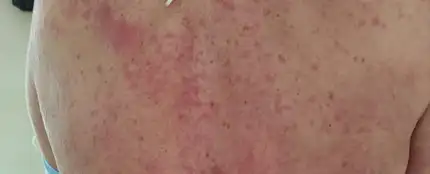 Efectos en la piel del coronavirus Efectos en la piel del coronavirus