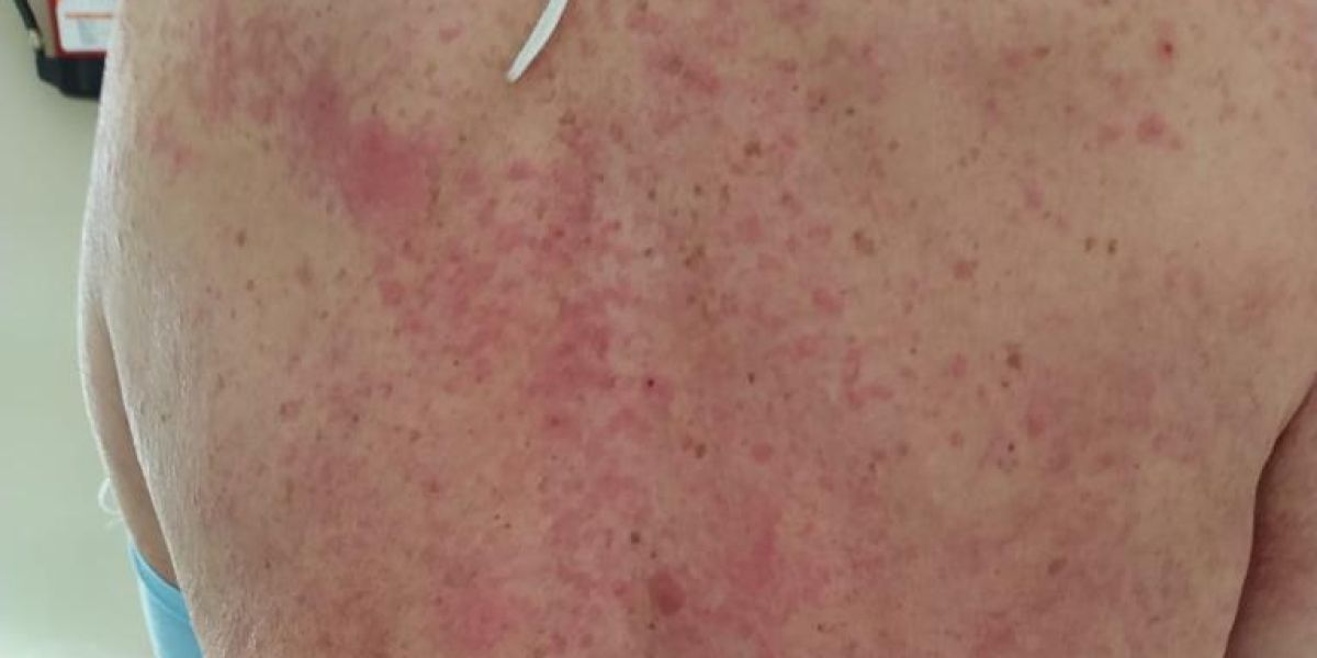 Efectos en la piel del coronavirus