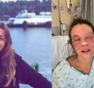 Imagen de Marta antes y después del accidente con sosa cáustica Imagen de Marta antes y después del accidente con sosa cáustica
