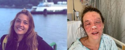 Imagen de Marta antes y después del accidente con sosa cáustica