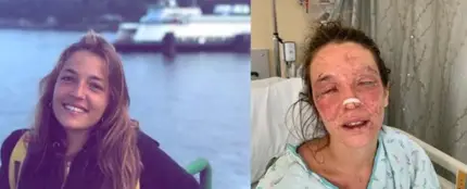 Imagen de Marta antes y después del accidente con sosa cáustica Imagen de Marta antes y después del accidente con sosa cáustica