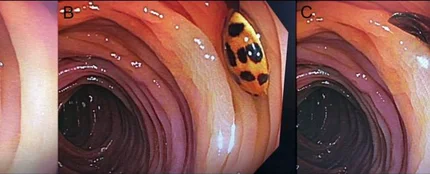 Mariquita en el intestino de un hombre Mariquita en el intestino de un hombre